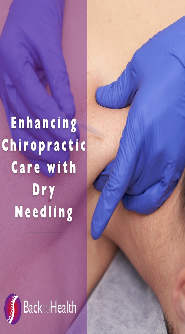 Enhancing Chiropractic Care with Dry Needling